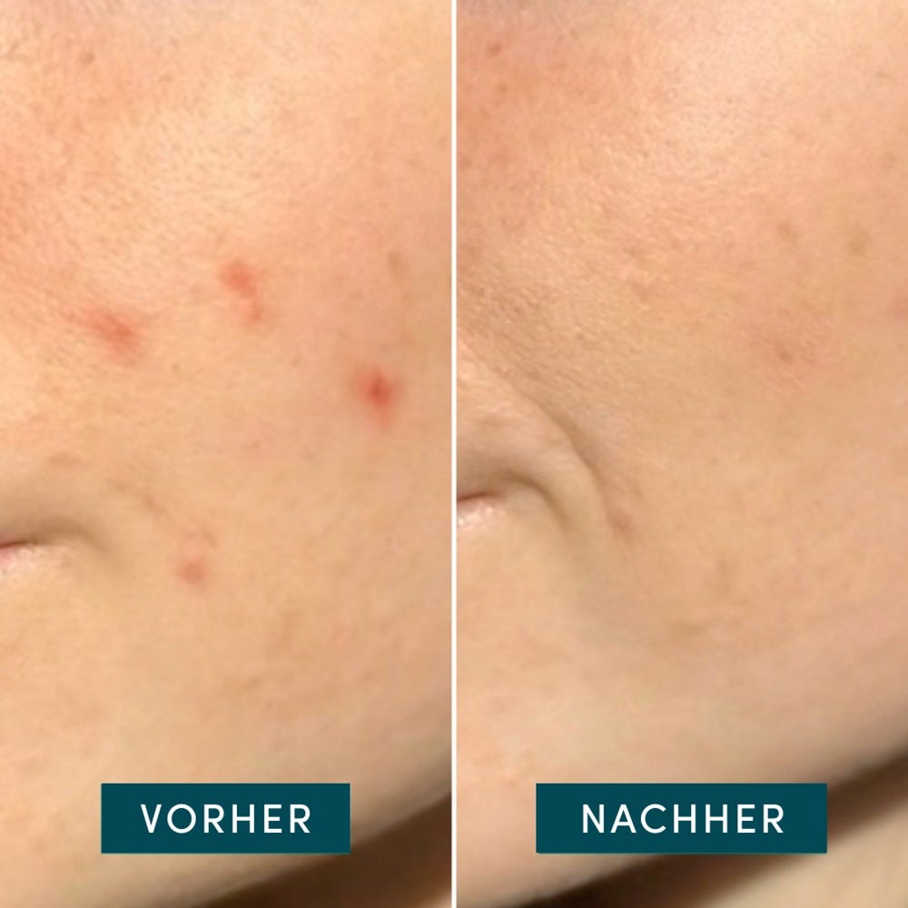 APRICOT Pimple Patches 72 Stück