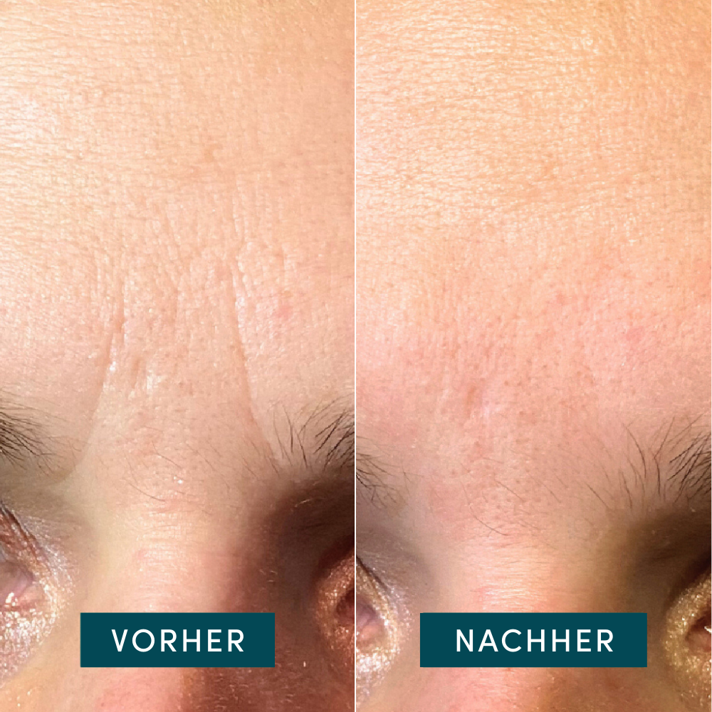 APRICOT Facial Patches 100 Stück
