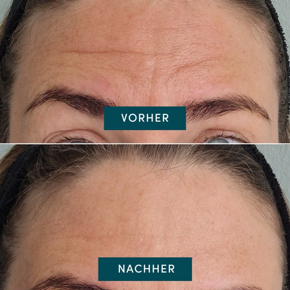 Apricot Wiederverwendbares Stirn Pad mit Vitamin C
