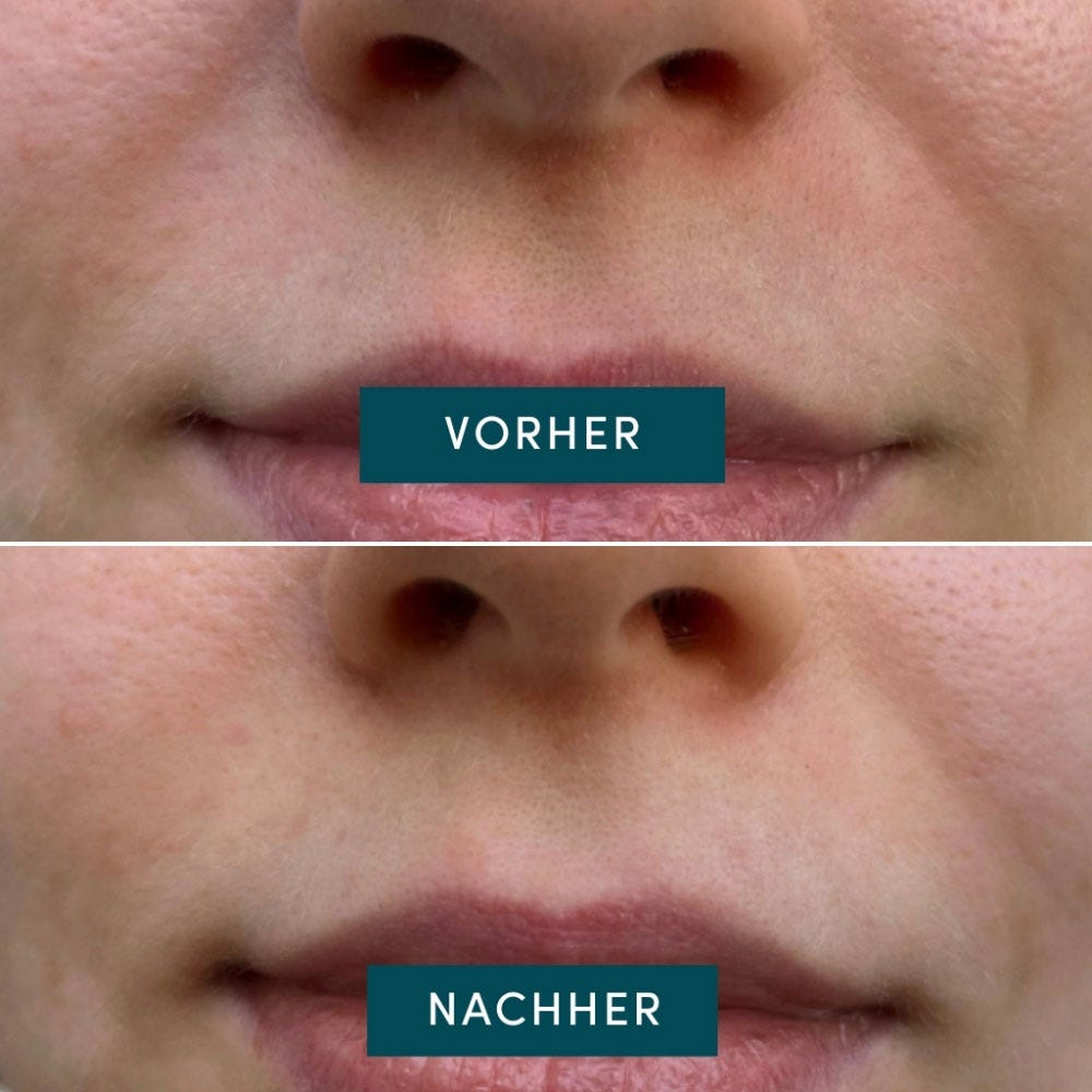 APRICOT Mund Patches mit Panthenol 100 Stück
