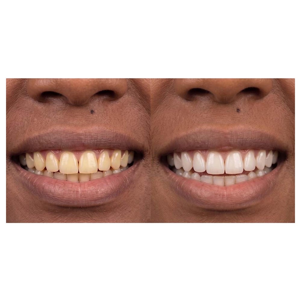 FOREO issa™ dual LED + sonic teeth whitening 1 Stück