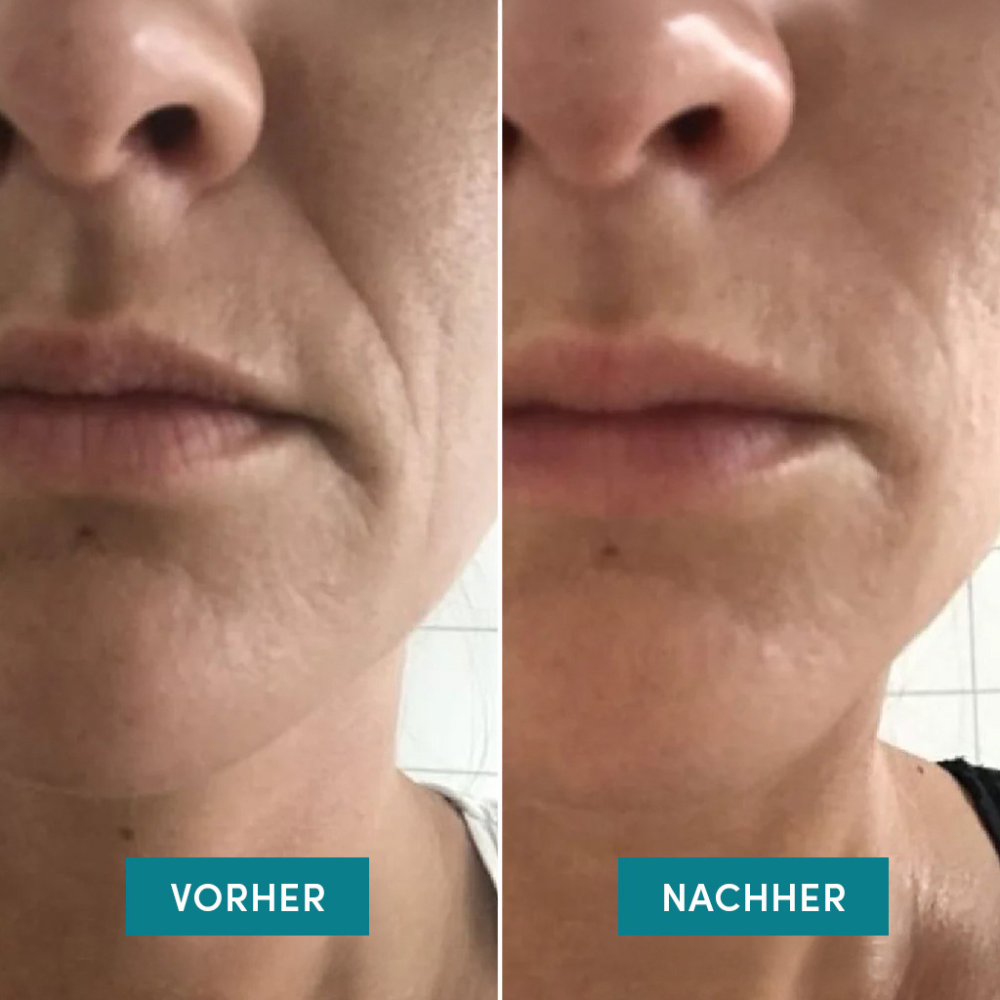 APRICOT Mund Patches mit Niacinamide